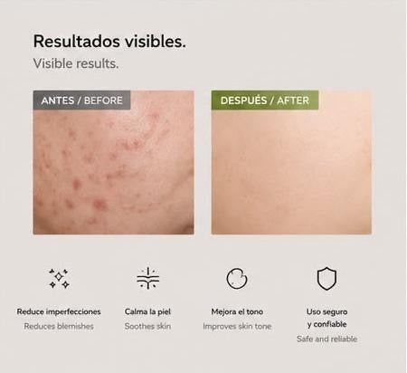 LEVARIA™ Pluma Antiacné con Luz Azul — Elimina Imperfecciones y Repara tu Piel Rápidamente